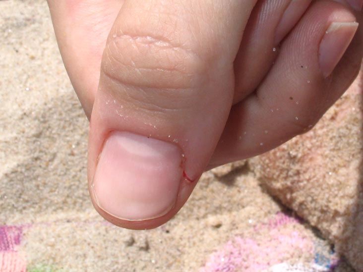 Crabbing at Mecox Beach, Long Island: The Injury