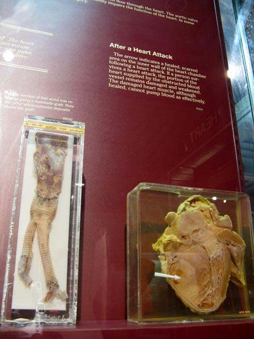 After A Heart Attack Display, Human Body, Human Being Exhibit, National Museum of Health and Medicine, Walter Reed Army Medical Center, 6900 Georgia Avenue NW, Washington, D.C.