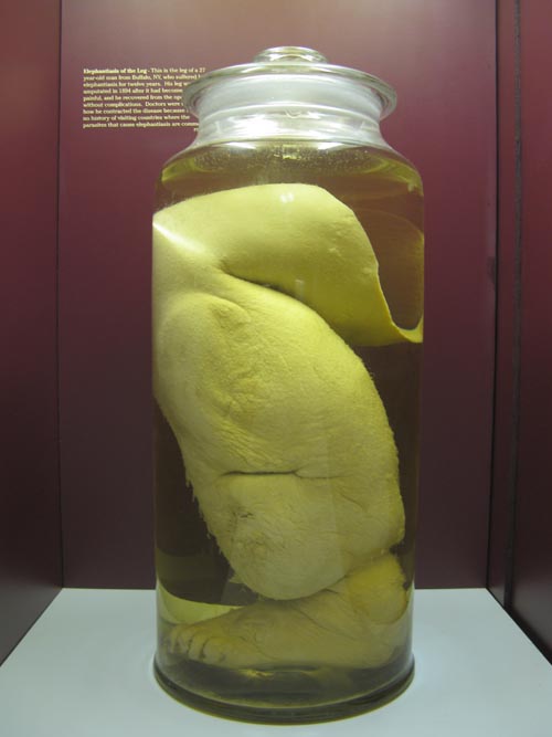 Elephantiasis of the Leg, Human Body, Human Being Exhibit, National Museum of Health and Medicine, Walter Reed Army Medical Center, 6900 Georgia Avenue NW, Washington, D.C.
