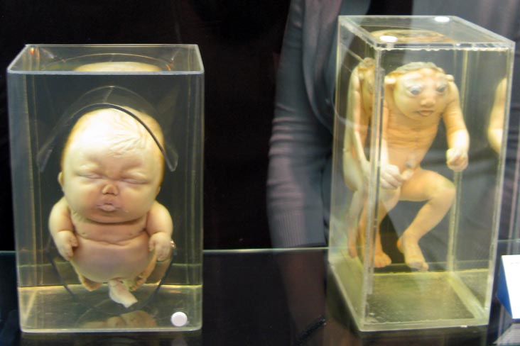 Achondroplastic Dwarfism and Anencephaly Specimens, From a Single Cell Exhibit, National Museum of Health and Medicine, Walter Reed Army Medical Center, 6900 Georgia Avenue NW, Washington, D.C.