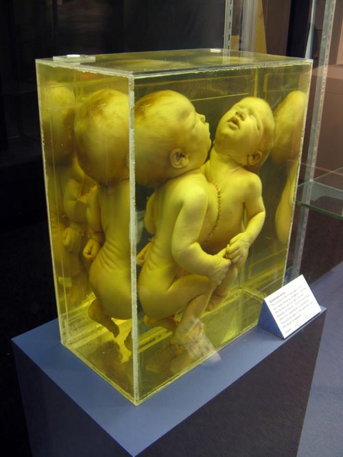 Conjoined Twins, From a Single Cell Exhibit, National Museum of Health and Medicine, Walter Reed Army Medical Center, 6900 Georgia Avenue NW, Washington, D.C.
