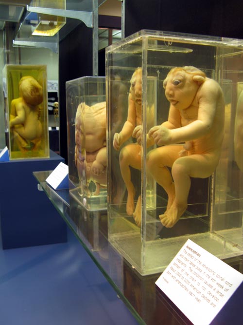 Conjoined Twins, Achondroplastic Dwarfism and Anencephaly Specimens, From a Single Cell Exhibit, National Museum of Health and Medicine, Walter Reed Army Medical Center, 6900 Georgia Avenue NW, Washington, D.C.