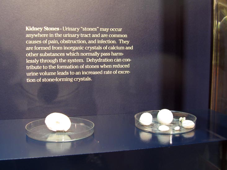 Kidney Stones, Human Body, Human Being Exhibit, National Museum of Health and Medicine, Walter Reed Army Medical Center, 6900 Georgia Avenue NW, Washington, D.C.