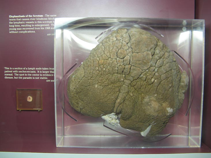 Elephantiasis of the Scrotum, Human Body, Human Being Exhibit, National Museum of Health and Medicine, Walter Reed Army Medical Center, 6900 Georgia Avenue NW, Washington, D.C.