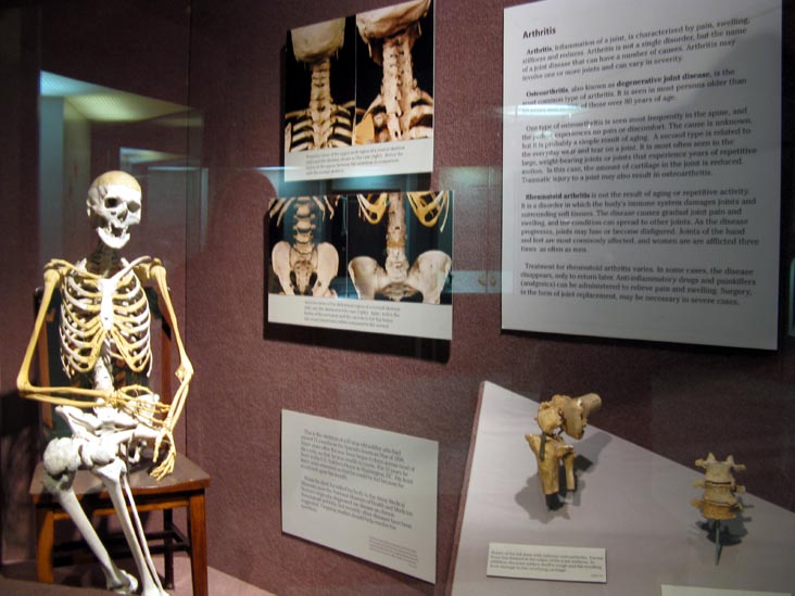 Arthritis Display, Human Body, Human Being Exhibit, National Museum of Health and Medicine, Walter Reed Army Medical Center, 6900 Georgia Avenue NW, Washington, D.C.