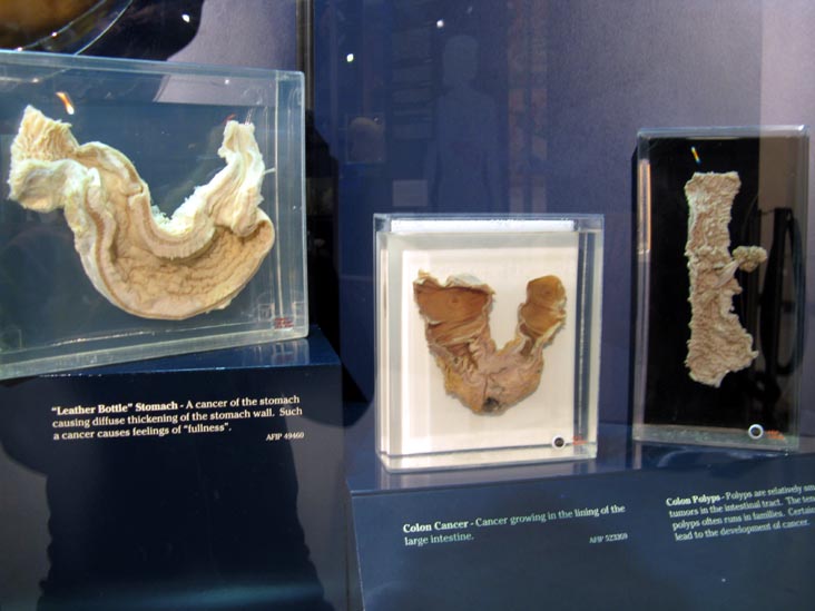 Leather Bottle Stomach, Colon Cancer and Colon Polyps Specimens, Human Body, Human Being Exhibit, National Museum of Health and Medicine, Walter Reed Army Medical Center, 6900 Georgia Avenue NW, Washington, D.C.