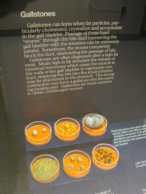 Gallstones, Human Body, Human Being Exhibit, National Museum of Health and Medicine, Walter Reed Army Medical Center, 6900 Georgia Avenue NW, Washington, D.C.